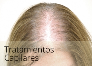 diapos_alopecia2